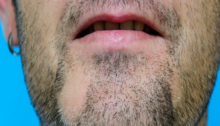 ریزش موی سکه ای : آموزش درمان کچلی ریش در مردان با طب سنتی