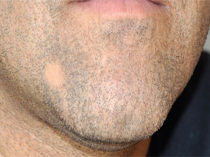 ریزش موی سکه ای : آموزش درمان کچلی ریش در مردان با طب سنتی